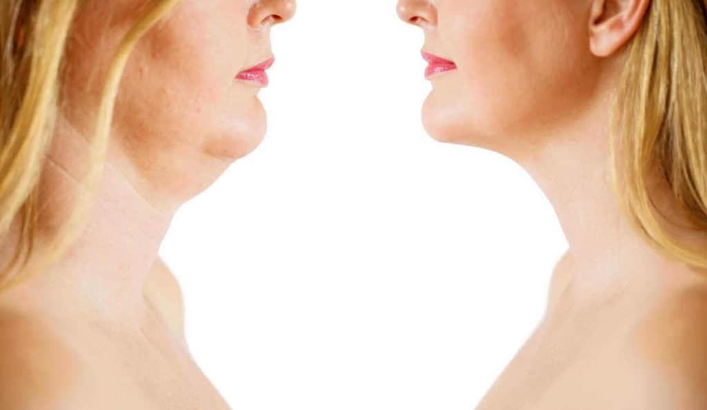 Double Chin treatment Brentford before and after results