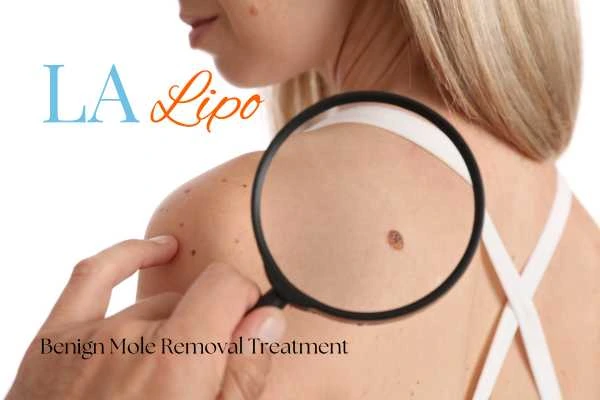 Woman having her inspection of blemish before mole removal Brentford