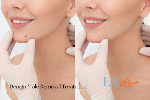 Before and after mole removal Brentford treatment