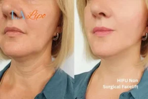 hi-fu for wrinkles Brentford before and after results