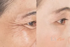 Before and after results of woman - HI-fu wrinkles reduction treatment Brentford