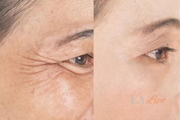 Before and after results of woman - HI-fu wrinkles reduction treatment Brentford