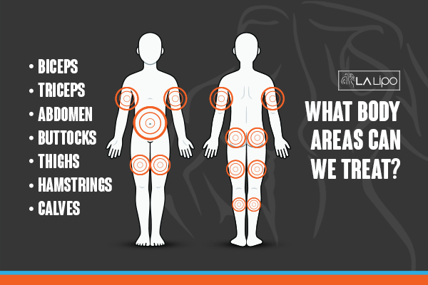 Graphic to show areas you can have LA-EMS Body Sculpting Brentford treatment.