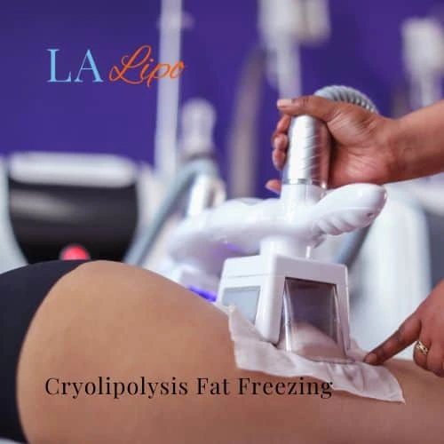 fat freezing - Cryolipolysis Brentford
