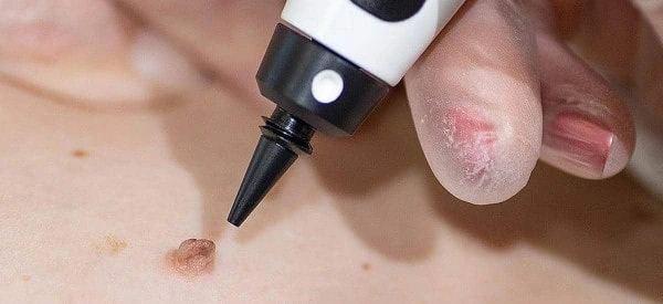 skin tag removal using cryopen Brentford