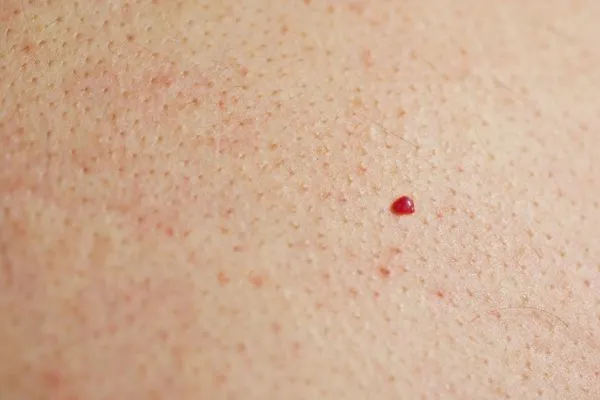 close up of a cherry angioma Brentford