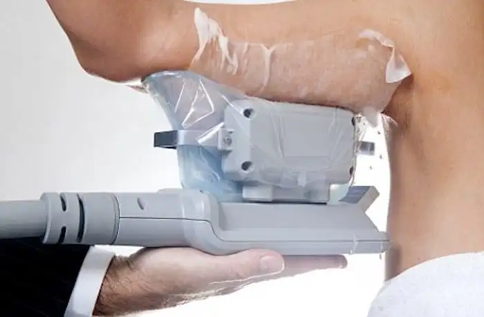 Picture of fat freezing Brentford on the upper arms.