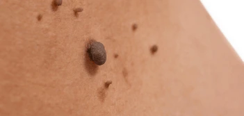 image of a skin tag Brentford