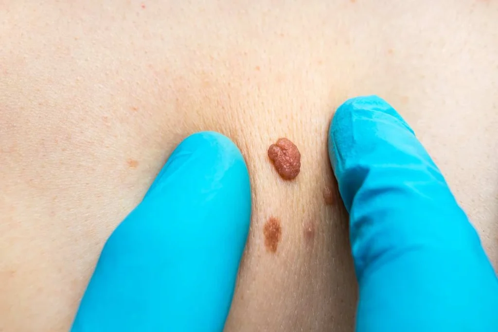 Consultant examining a skin tag Brentford