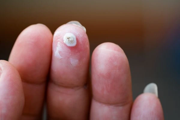 wart on person finger - cryotherapy to treat from LA LIPO Brentford