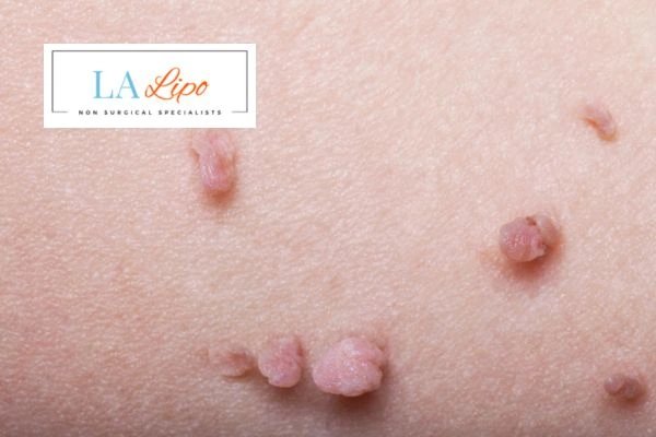 Does cryopen skin tag removal Brentford hurt? Find out now call our team today!