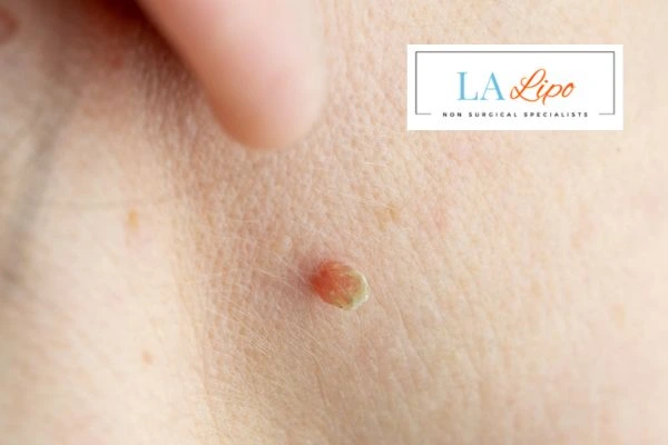 Book skin tag removal Brentford today speak to our team now!