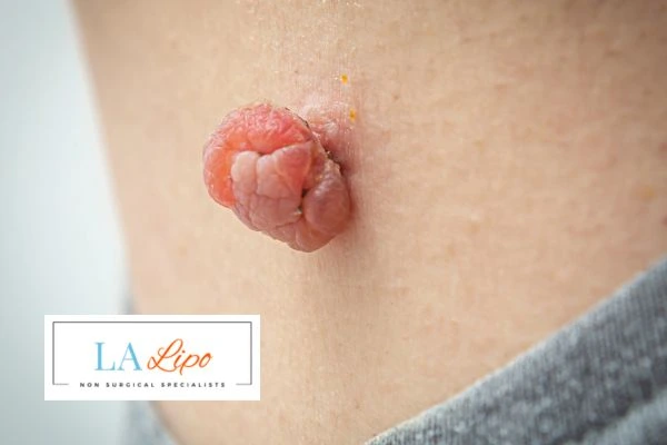 Interested in skin tag removal Brentford? Concerned about the pain? Find out more today!