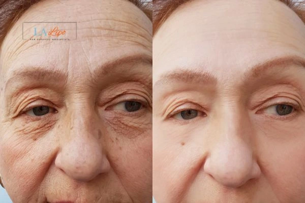 The powerful benefits of Morpheus8 Treatment Brentford - Call Our team today!