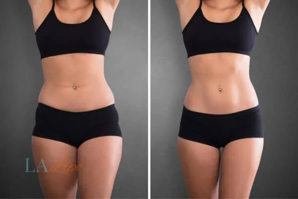 before and after results of non-surgical treatment to help a woman's body image and mental health Brentford