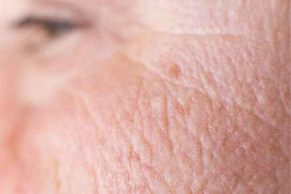 close up picture of a woman's face showing an age spot Brentford
