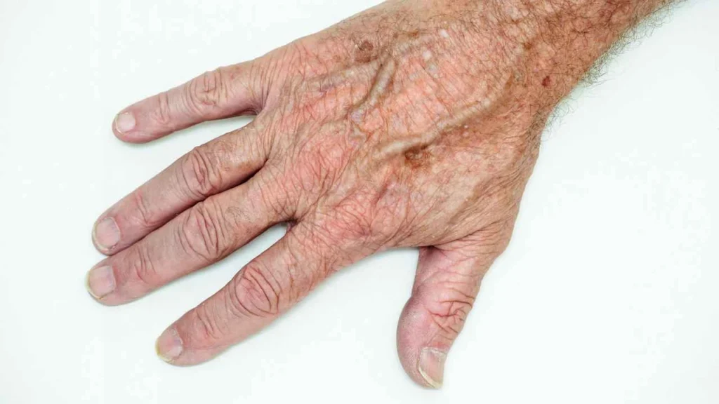 Male hand showing age spot Brentford