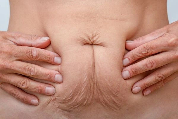 Should I Combine Diastasis Recti Treatment with Body Contouring for Better Results Brentford?