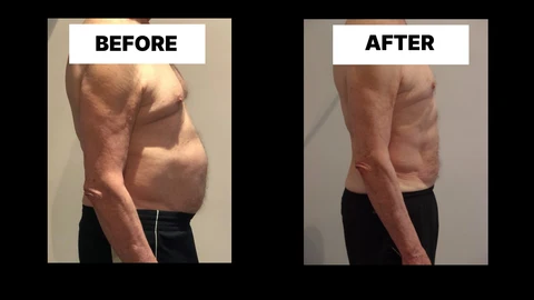 What Symptoms Can Diastasis Recti Cause in Men? Weak Core, Back Pain and Poor Posture Brentford
